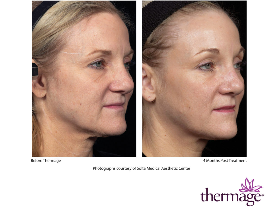 Thermage Cosmetic Laser Centers