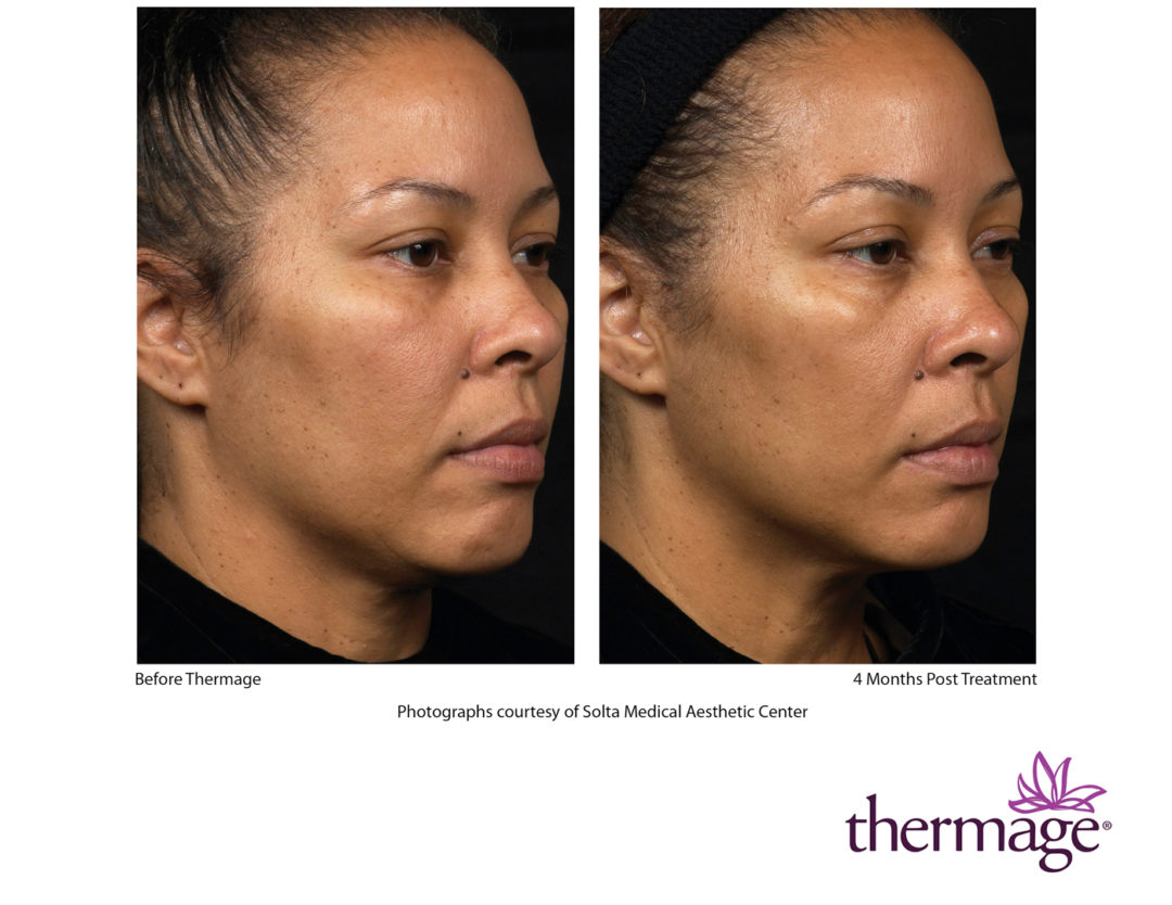 Thermage Cosmetic Laser Centers