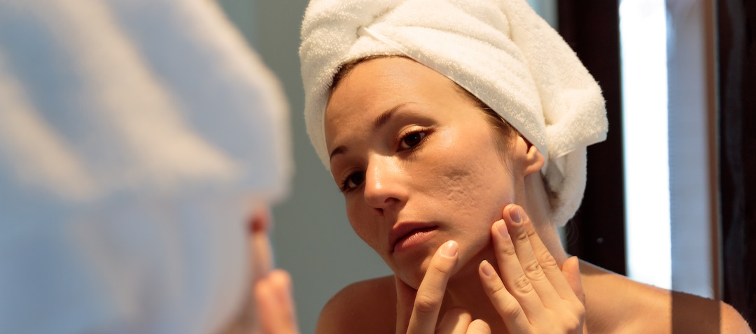 woman looking at acne scars